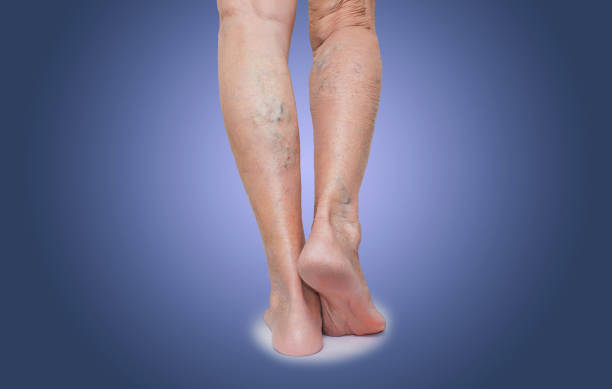 Abnormal Veins