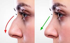 Rhinoplasty