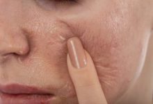 An Analysis of the Potential Advantages of Chemical Peel and Vi Peel Procedures in East Brunswick, NJ