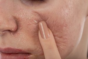 An Analysis of the Potential Advantages of Chemical Peel and Vi Peel Procedures in East Brunswick, NJ