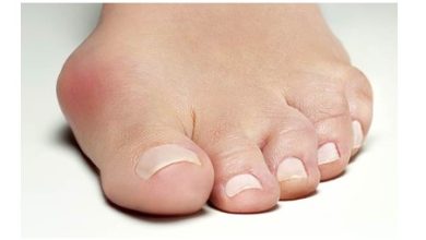 Comprehensive Guide to Bunion Surgery What You Need to Know