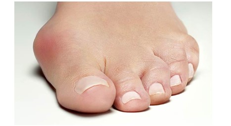 Comprehensive Guide to Bunion Surgery What You Need to Know