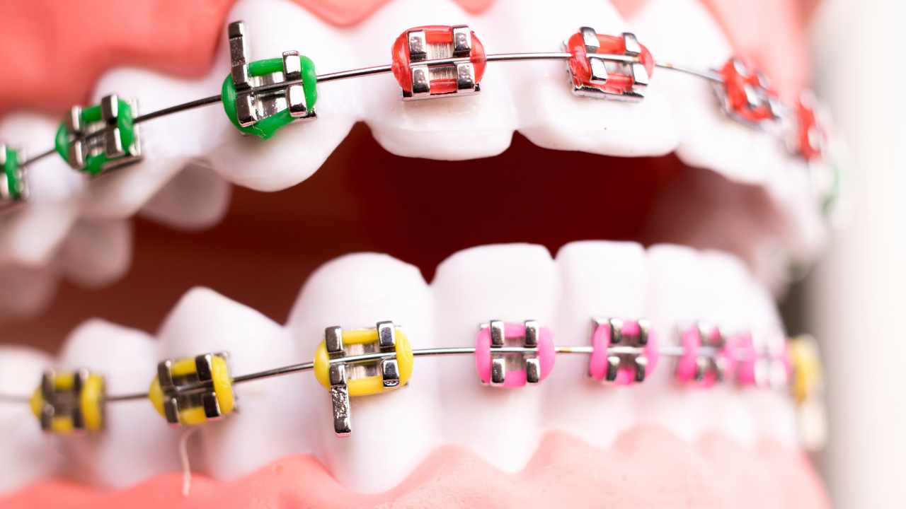 Introduction to Metal Braces: Straightening Smiles with Confidence
