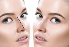 Rhinoplasty