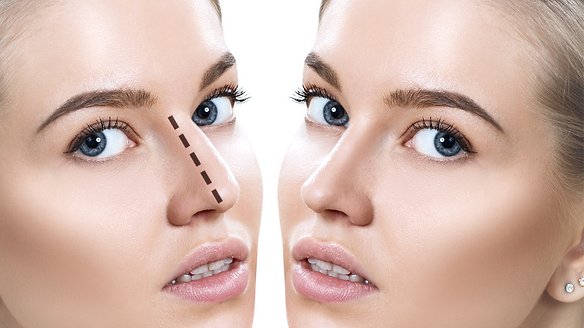 Rhinoplasty