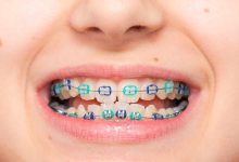 The Cost of Braces in Elmhurst: Understanding the Financial Investment for a Straighter Smile