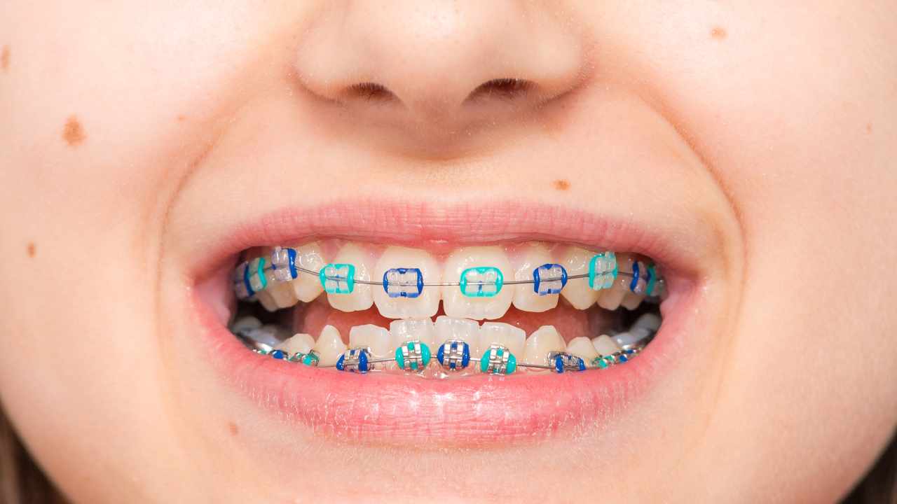 The Cost of Braces in Elmhurst: Understanding the Financial Investment for a Straighter Smile